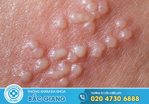 Hình ảnh nổi mụn ở vùng kín nữ giới và cách trị