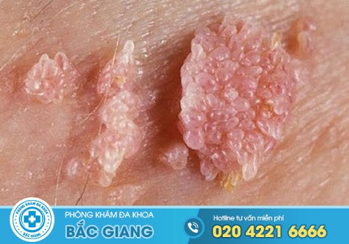Hình ảnh bệnh sùi mào gà ở Nam và Nữ giai đoạn đầu