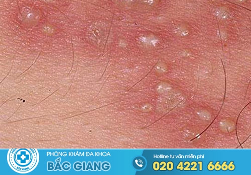 Hình ảnh bệnh sùi mào gà ở Nam và Nữ giai đoạn đầu