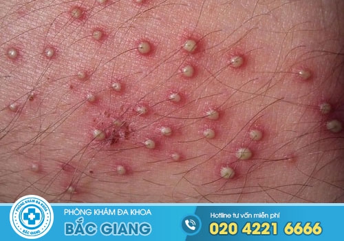Mọc mụn bọc ở môi lớn vùng kín có Nguy Hiểm không