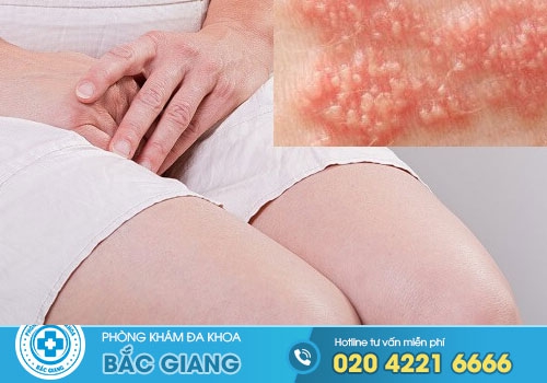 Hình ảnh bệnh sùi mào gà ở Nam và Nữ giai đoạn đầu