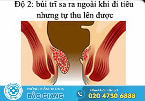 Hình ảnh bệnh trĩ nội và trĩ ngoại qua từng cấp độ