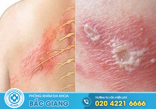 TOP 9 Phòng khám Da Liễu tại Yên Thế Bắc Giang Uy Tín