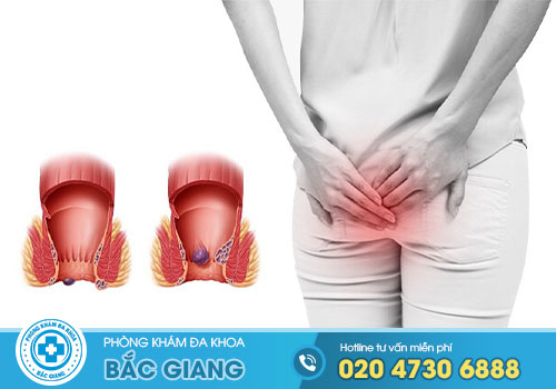 Hình ảnh bệnh trĩ nội và trĩ ngoại qua từng cấp độ