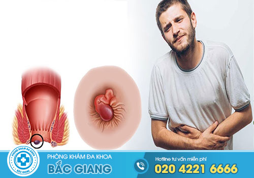 TOP 10 Khám, Chữa bệnh Trĩ ở Hiệp Hòa Bắc Giang tốt nhất