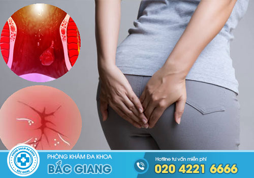 TOP 8 Địa chỉ Cắt Trĩ ở Hiệp Hòa Bắc Giang tốt nhất